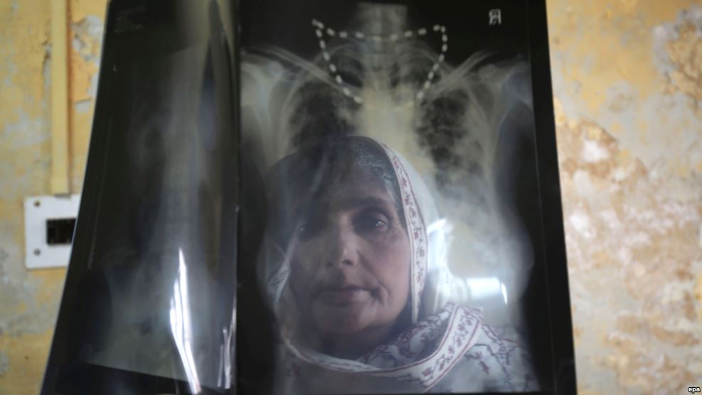 В Таджикистане заработает еще 31 аппарат для диагностики туберкулеза
